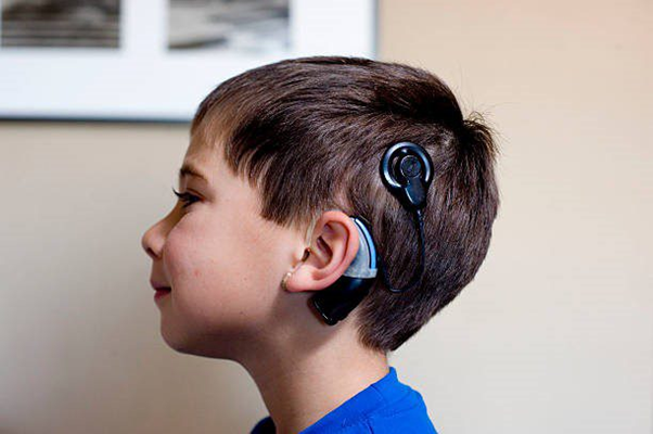 Cochlear Implants: A Surgical Solution for Severe Deafness